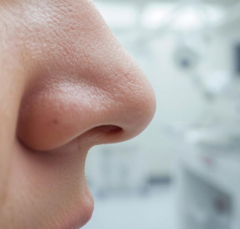Korrektur der äußeren Nasenform (Septo-/Rhinoplastik) durch den Operateur PD Dr. med. Philipp Wolber.